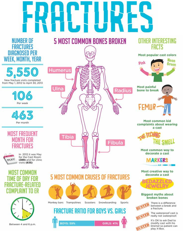 How children fracture their bones and the 5 most common causes of broken bones.
