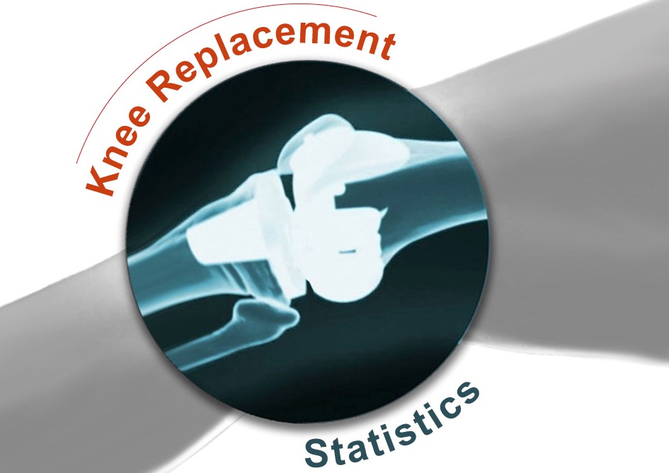 Knee Replacement Success Statistics