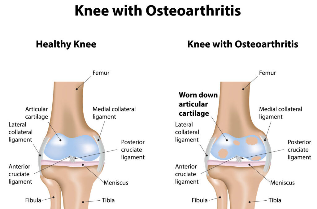 Knee Pain from Osteoarthritis