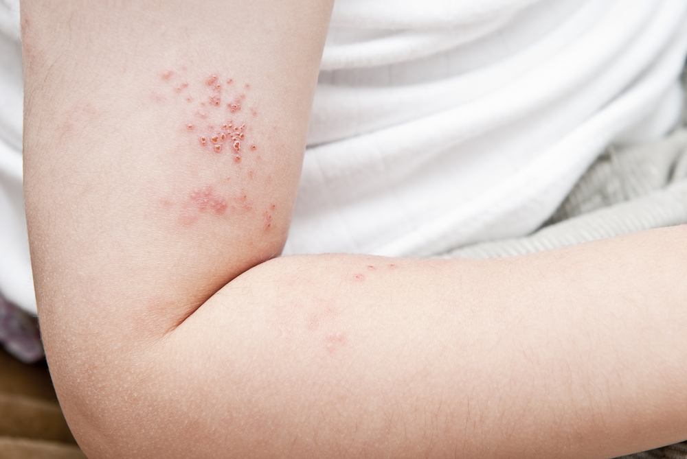 Understanding Shingles and Treating This Debilitating Pain