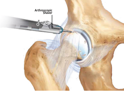 hip cartilage arthroscopic shaver