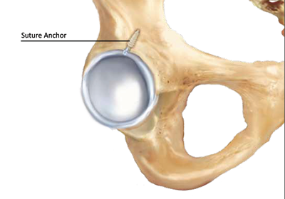 labral hip tear repair