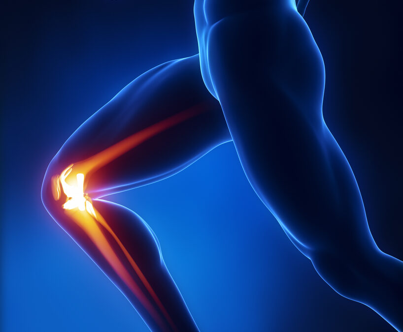 ACL Injury Prevention in Athletes